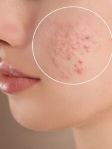 5 Effective Tips to Reduce Acne at Home
